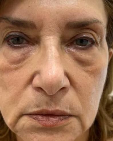 Rosto de frente, com atenção à zona dos olhos, antes do tratamento