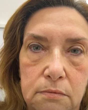 O mesmo rosto, com atenção à zona dos olhos, depois do tratamento