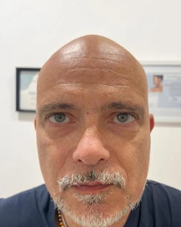 O mesmo rosto de frente, depois do tratamento