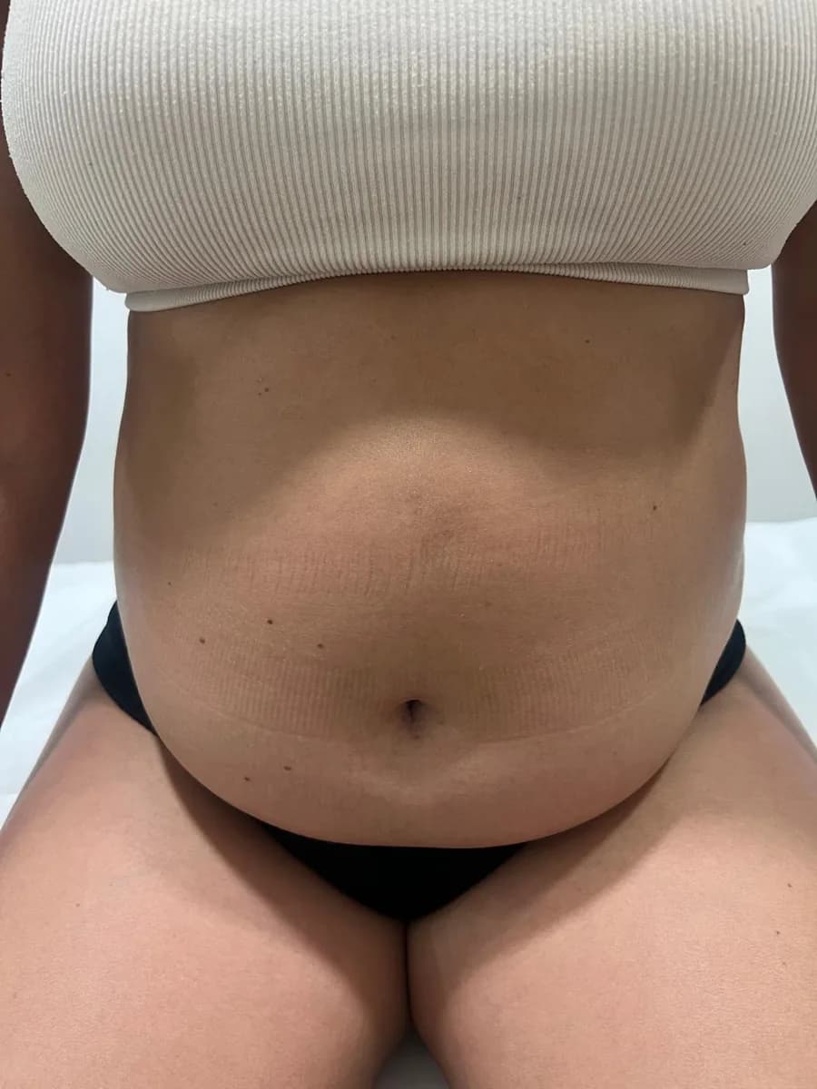 Abdomen from the front, before the session