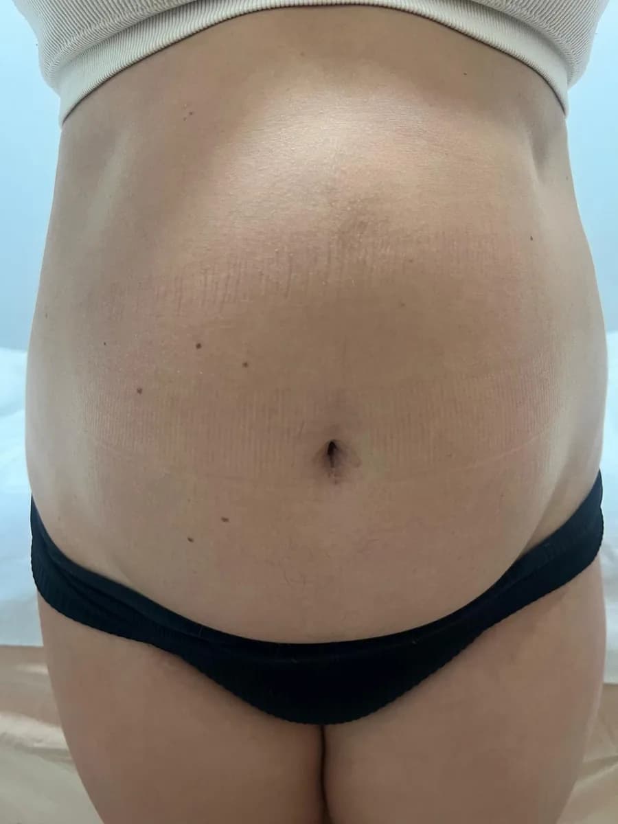 Abdomen from the front, before the session