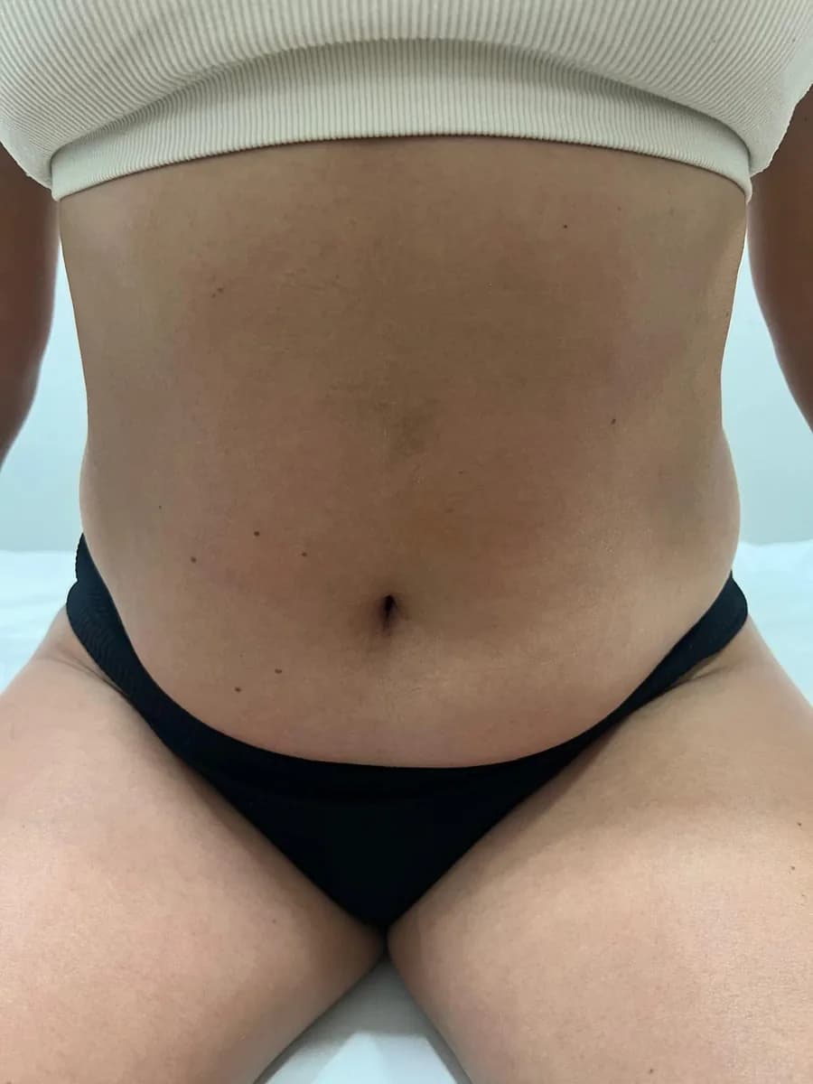 The same abdomen from the front, after the session