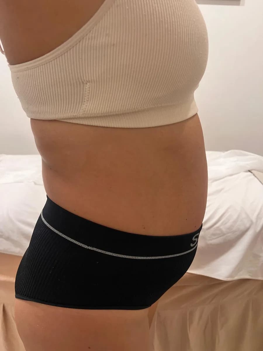 The same abdomen from the side, after the session