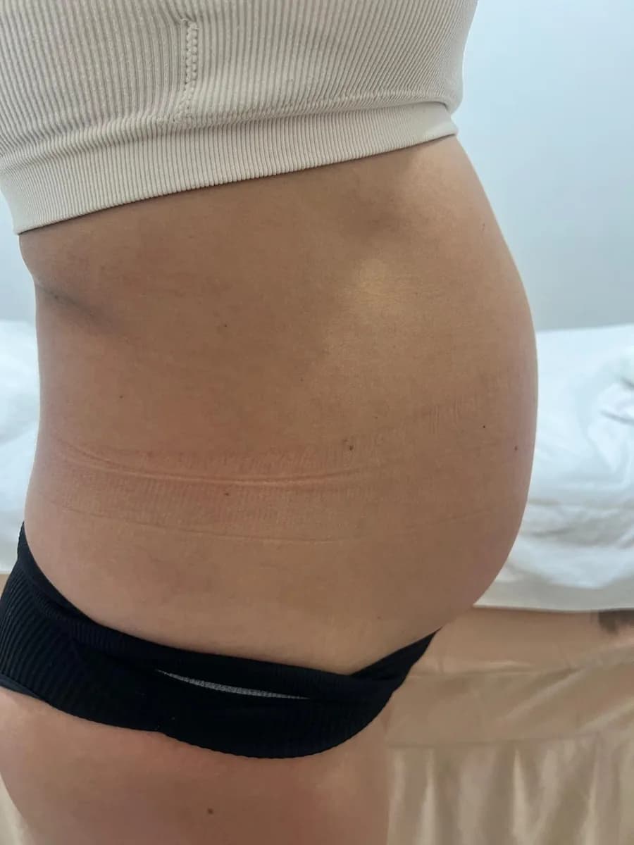 The same abdomen from the side, before the session
