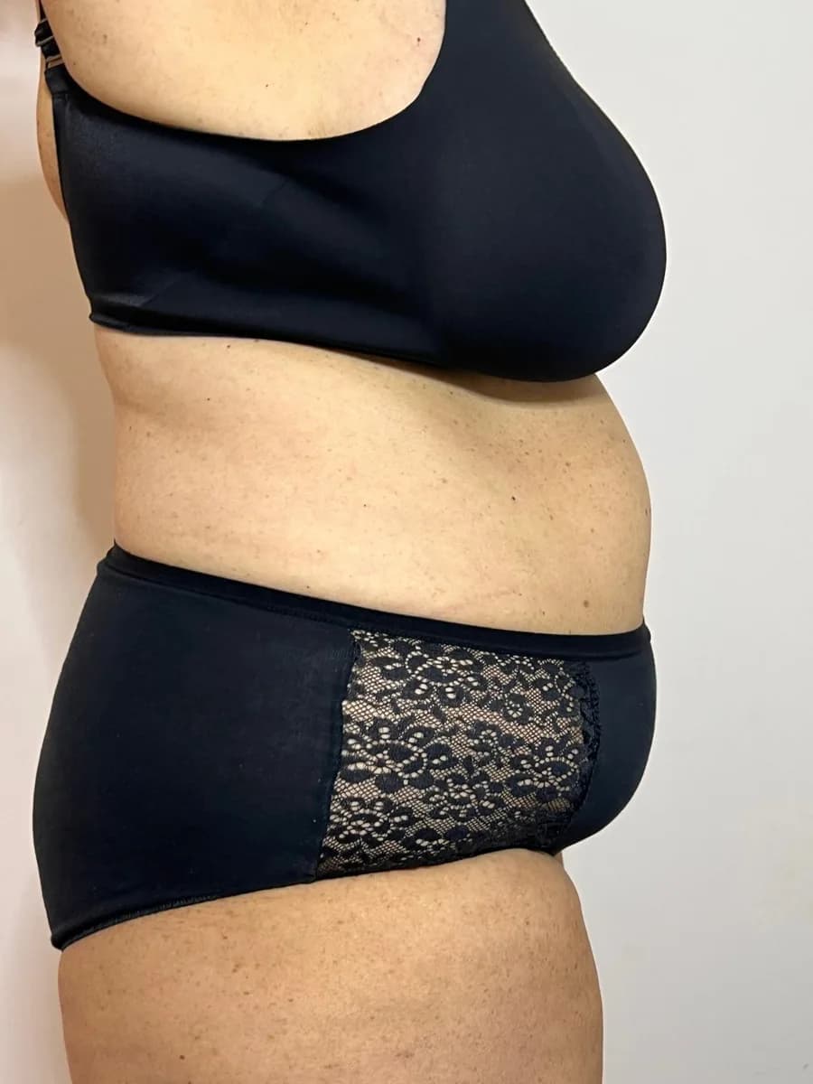 Abdomen from the side, before the session