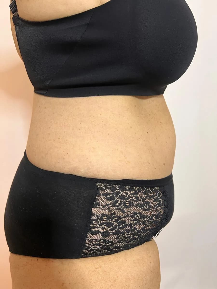 The same abdomen from the side, after the session