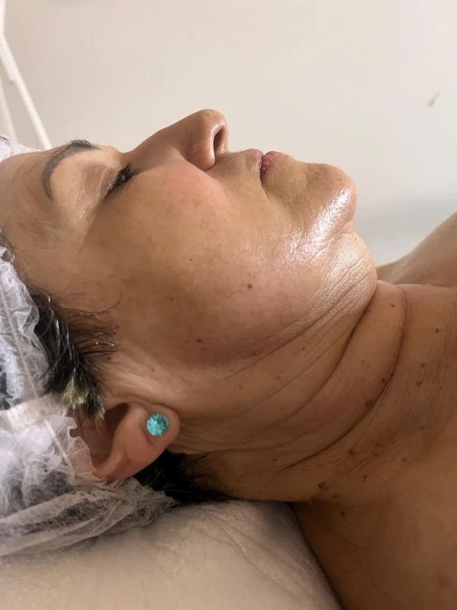 The same jaw and neck from the side, after the session