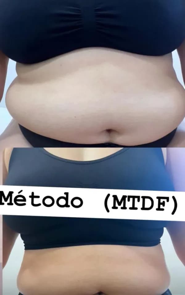 An abdomen from the front, before above and after below, captioned “Método (MTDF)”.