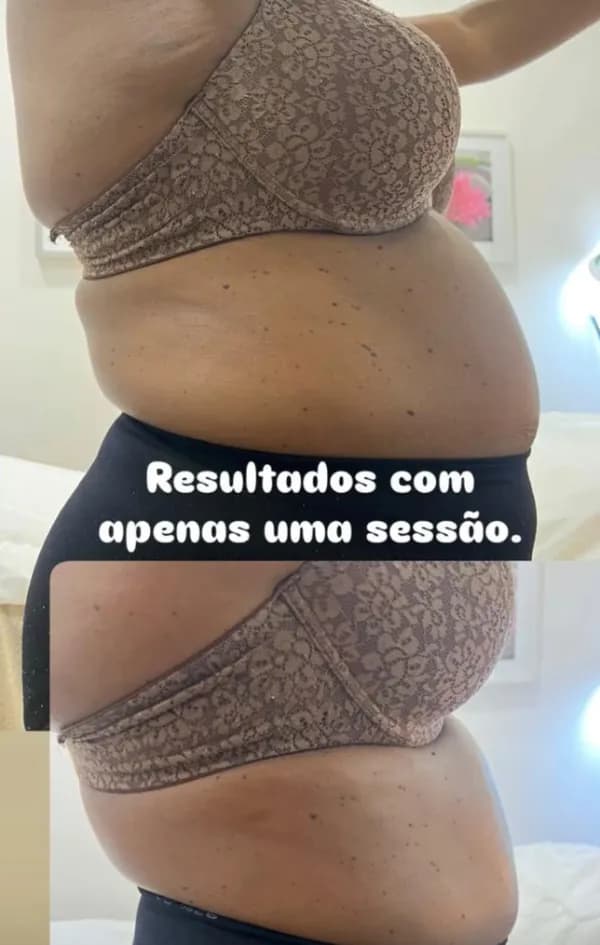 An abdomen from the side, before above and after below, captioned “Results from just one session”.