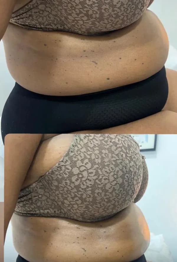 A waist and flank from the side, before above and after below.